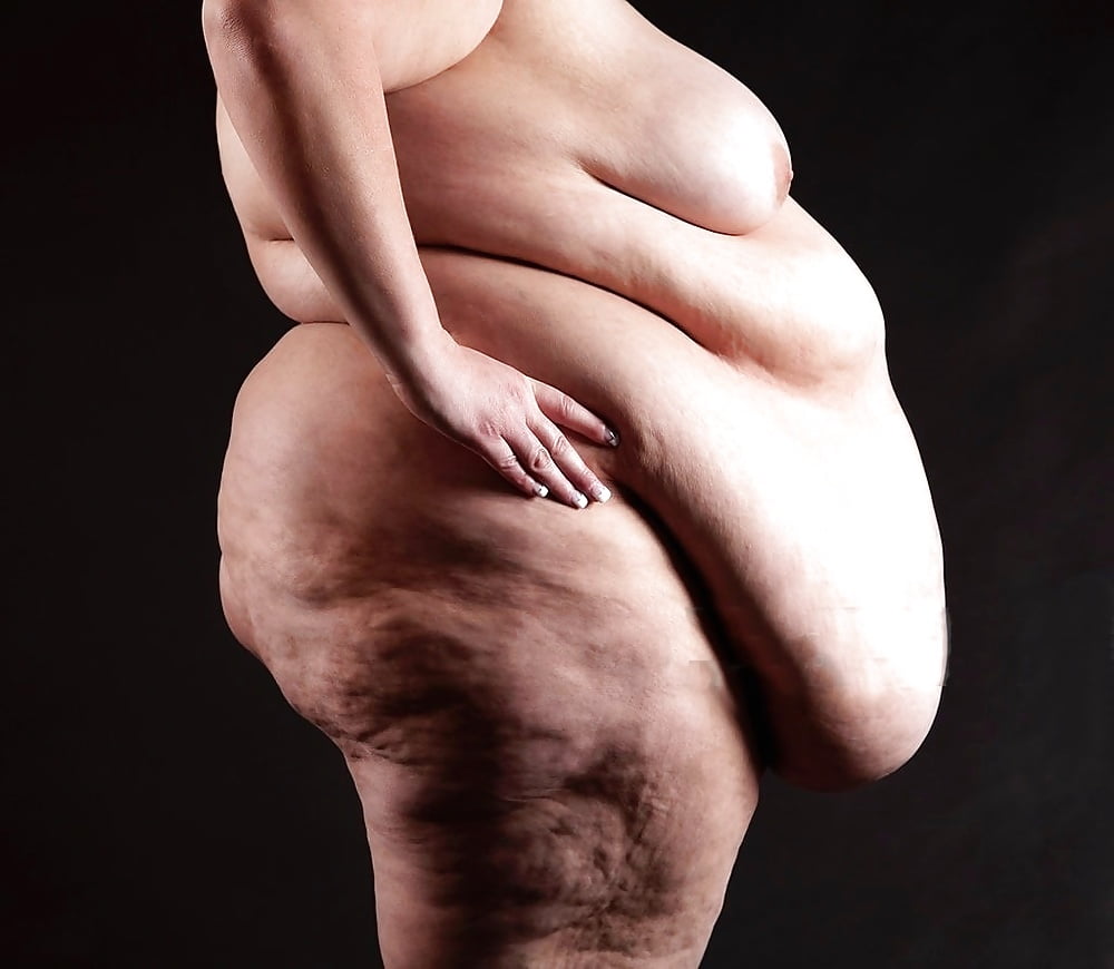 Naked Morbidly Obese Women.