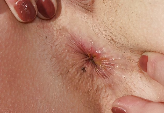 white girl spreading ass 1 pict gal