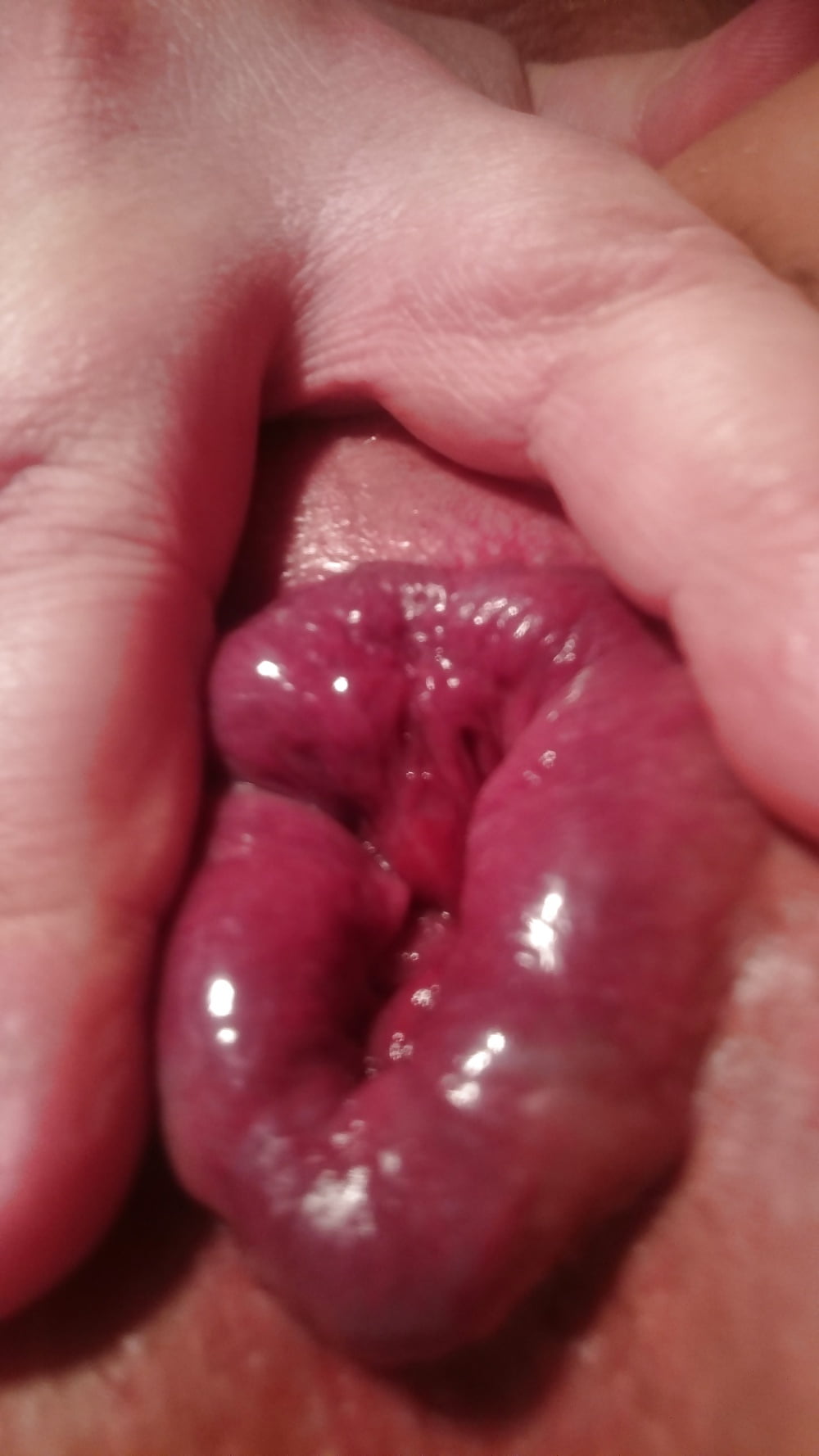 Bumhole (light prolapse) pict gal