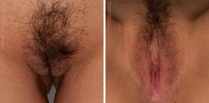 Que hace el vinagre blanco en la vulva