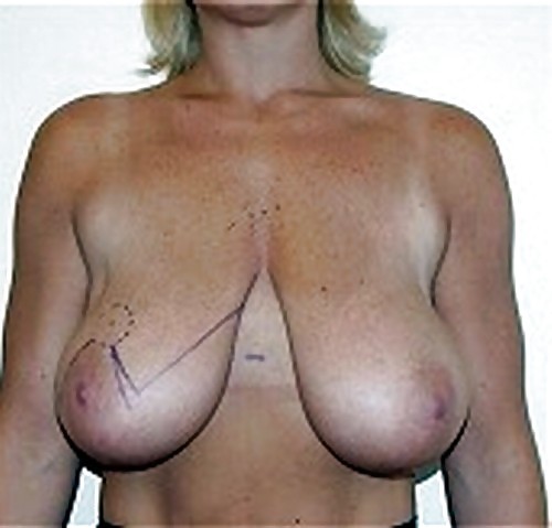Big Natural And Saggy Tits Pre-OP Pictures pict gal
